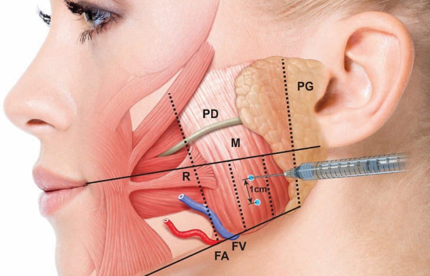 xóa cằm vuông bằng botox